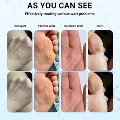 Wart Remover Fast Acting Gel Wart Remover